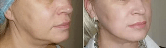 Easy skin rejuvenation