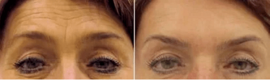 Forehead rejuvenation