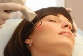 the essence of the procedure for fractional facial skin rejuvenation with laser